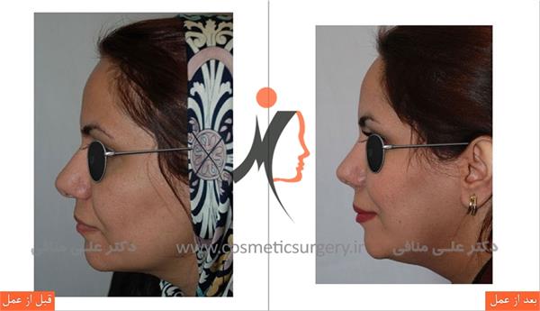 Rhinoplasty 1