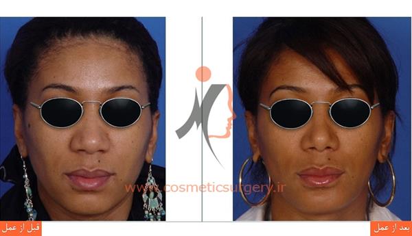 جراحی بینی گوشتی