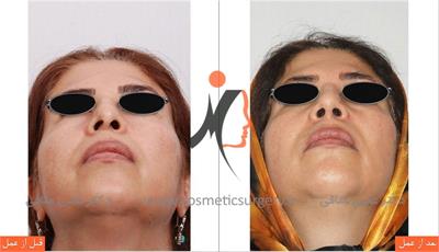 secondary rhinoplasty