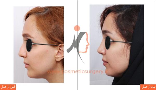 جراحی زیبایی بینی 2
