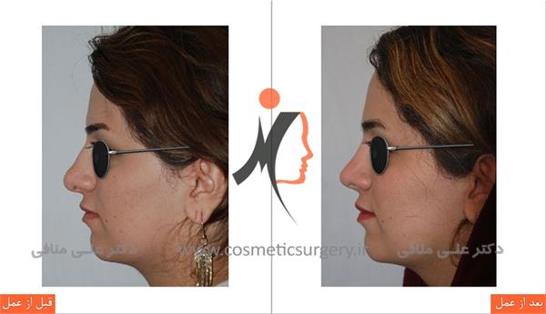 Rhinoplasty 1