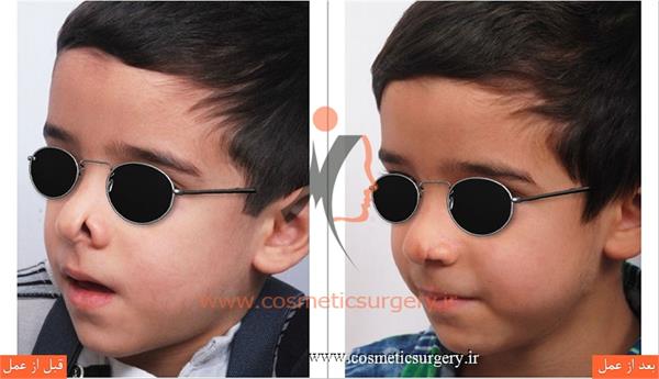 ترمیم نقص مادر زادی بینی