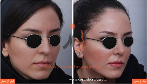 Rhinoplasty