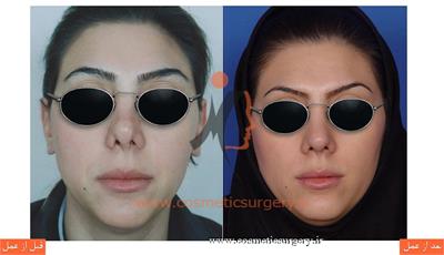 ترمیم بینی در بیماری که قبلا توسط جراحان دیگری عمل شده است