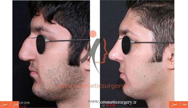 جراحی زیبایی بینی به همراه ترمیم شکاف لب و کام