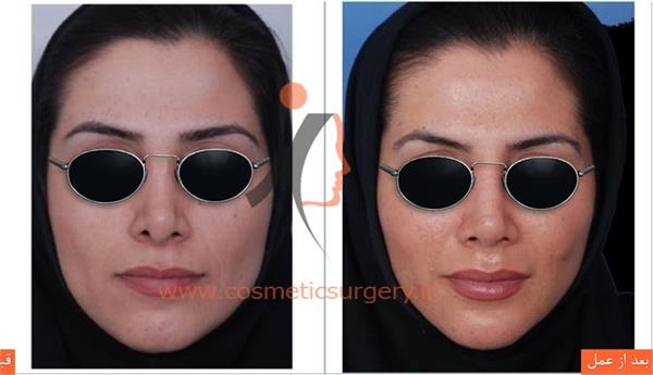 ترمیم بینی به همراه تزریق چربی