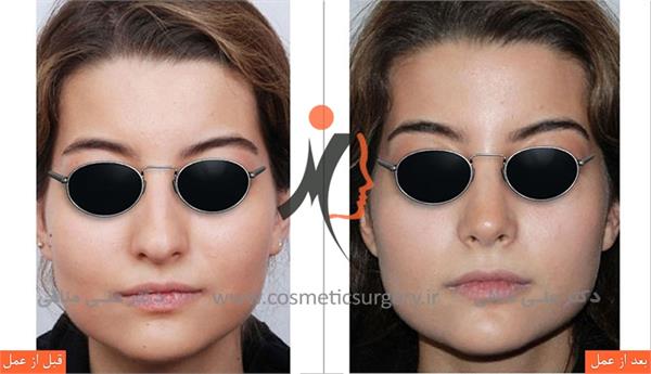 nouse cosmetic surgery 5