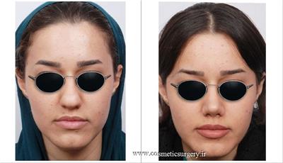 جراحی زیبایی بینی 1