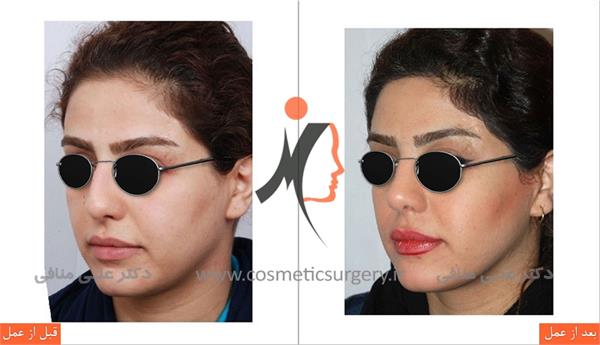 عمل جراحی زیبایی بینی 2