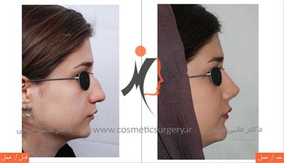 thick skinned rhinoplasty 3