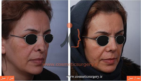 ترمیم بینی در بیماری که قبلا توسط جراحان دیگری عمل شده است