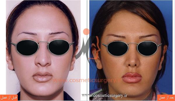 جراحی زیبایی بینی