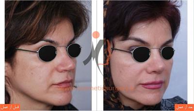 ترمیم بینی در بیماری که قبلا توسط جراحان دیگری عمل شده است