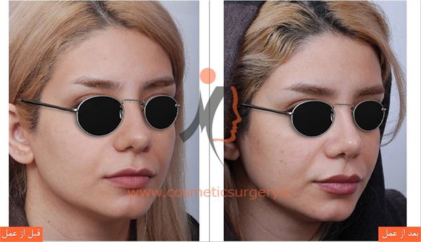 جراحی زیبایی بینی
