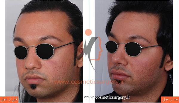 عمل جراحی بینی گوشتی