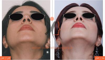 جراحی زیبایی بینی