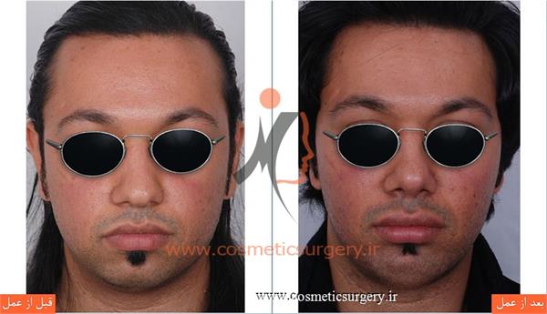 عمل جراحی بینی گوشتی