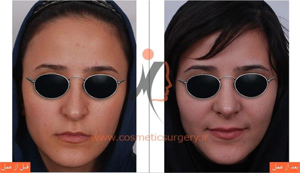 جراحی زیبایی بینی