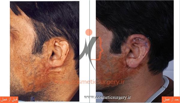 جراحی گوش ( بازسازی گوش سوخته )