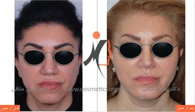 Surgical Chin Surgery 2