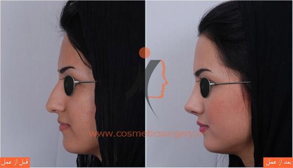 جراحی زیبایی بینی