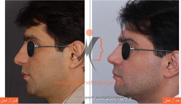 عمل جراحی انحراف بینی