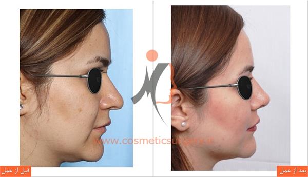 جراحی زیبایی بینی  3