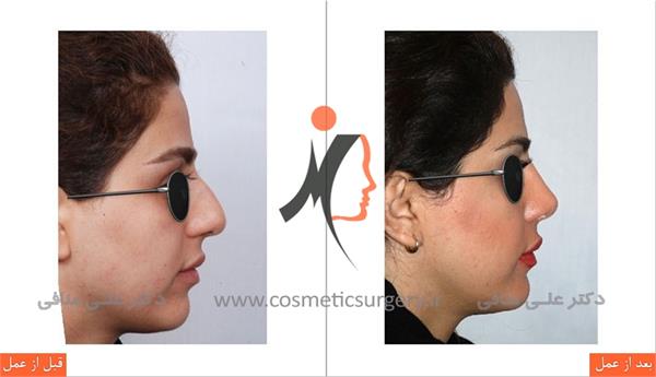 Rhinoplasty 1