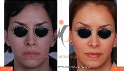 تزریق چربی صورت و گونه