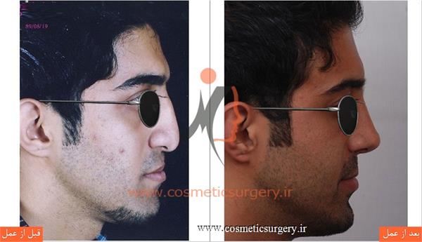 جراحی زیبایی بینی به همراه ترمیم شکاف لب و کام