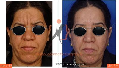 لیفت پیشانی با پوست بسیار ضخیم