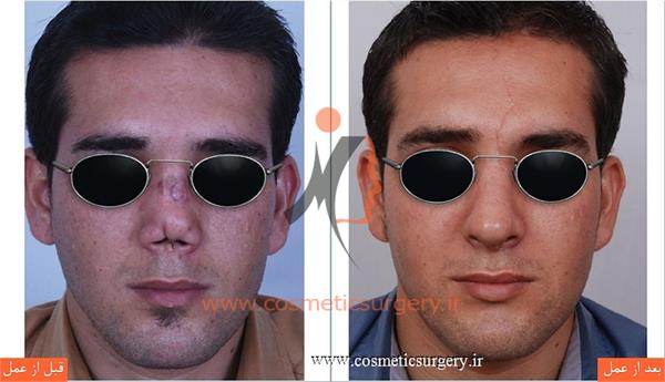 ترمیم بینی در بیماری که قبلا توسط جراحان دیگری عمل شده است