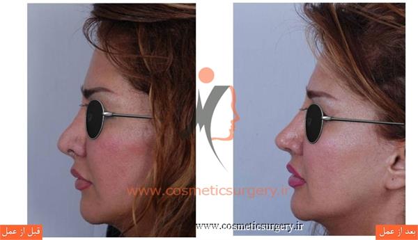 ترمیم بینی در بیماری که قبلا توسط جراحان دیگری عمل شده است