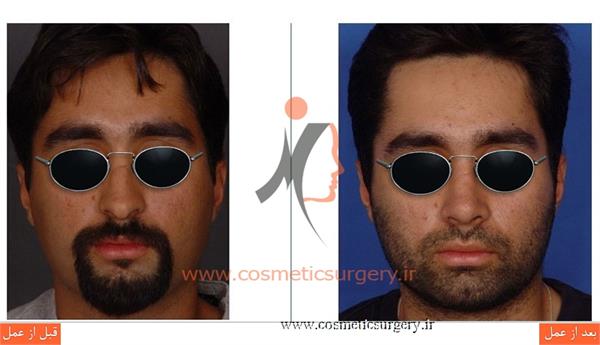 جراحی زیبایی بینی