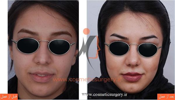 جراحی زیبایی بینی
