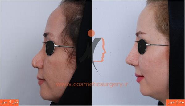 ترمیم بینی عمل شده توسط جراحان دیگر 4