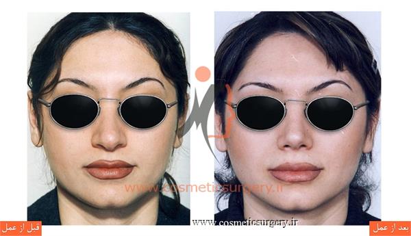 جراحی زیبایی بینی