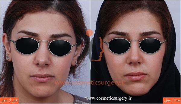 عمل جراحی انحراف بینی