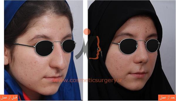 جراحی زیبایی بینی