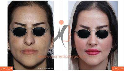 جراحی زیبایی بینی