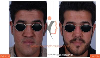 ترمیم بینی در بیماری که قبلا توسط جراحان دیگری عمل شده است