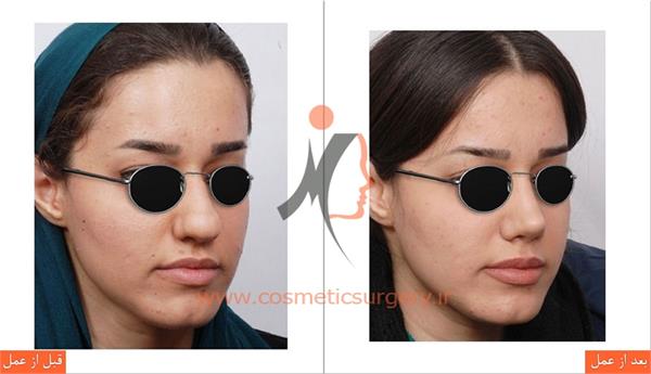 جراحی زیبایی بینی 2