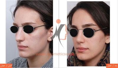 جراحی زیبایی بینی 1