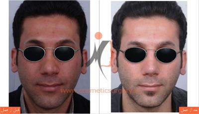 ترمیم بینی در بیماری که قبلا توسط جراحان دیگری عمل شده است