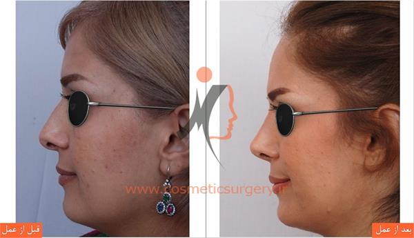 جراحی زیبایی بینی