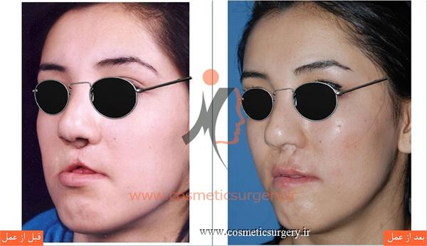 جراحی و ترمیم شکاف لب و کام