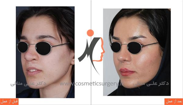 عمل ترمیم بینی شکاف لب E6