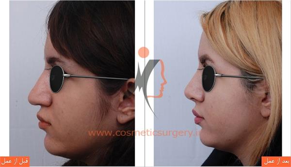 جراحی زیبایی بینی
