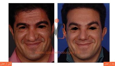 لیفت پیشانی به همراه جراحی بینی 1