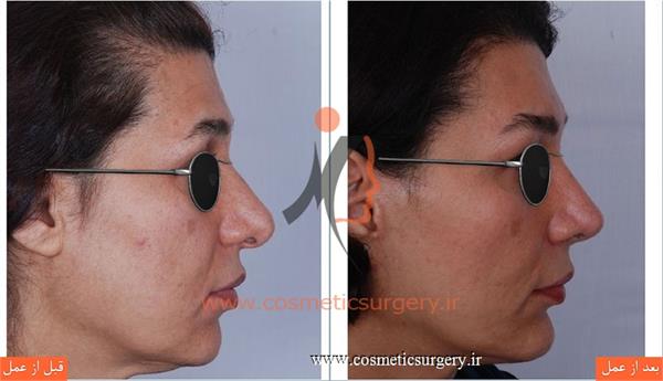 جراحی زیبایی بینی بهمراه لیفت صورت و تزریق چربی